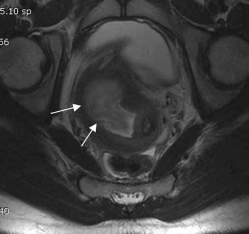 Transabdominal US image shows didelphic uterus and low echoic fluid collection in right uterine cavity (black arrows).