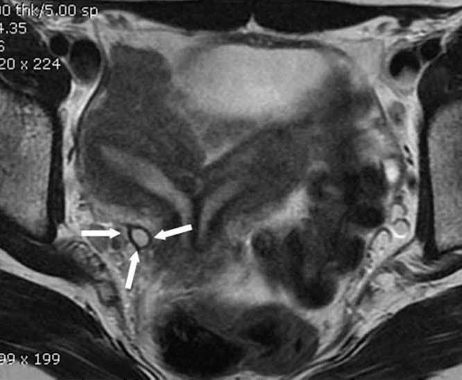 MRI를시행했던 4예중 2예 ( 증례2, 5) 에서는병변쪽골반강에관상구조물이질주변으로연결되어있었으며, T1, T2 강조영상에서고신호강도로보여이소성요관의가능성이있을것으로생각하였다 (Fig. 2). 5예중 2예 ( 증례1, 3) 에서는질혈증과복부통증이있어질 A B C D Fig. 2. Case 2, A 16-year-old girl with abdominal pain during menstrual periods.