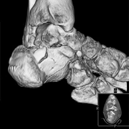 () Sagittal reformatted CT image clearly shows the fracture line extending