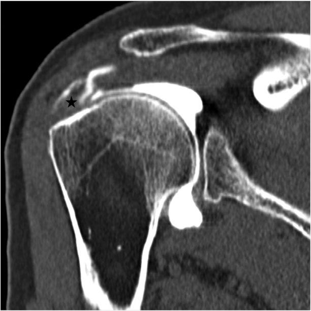 patient with full-thickness tears of supraspinatus tendon.