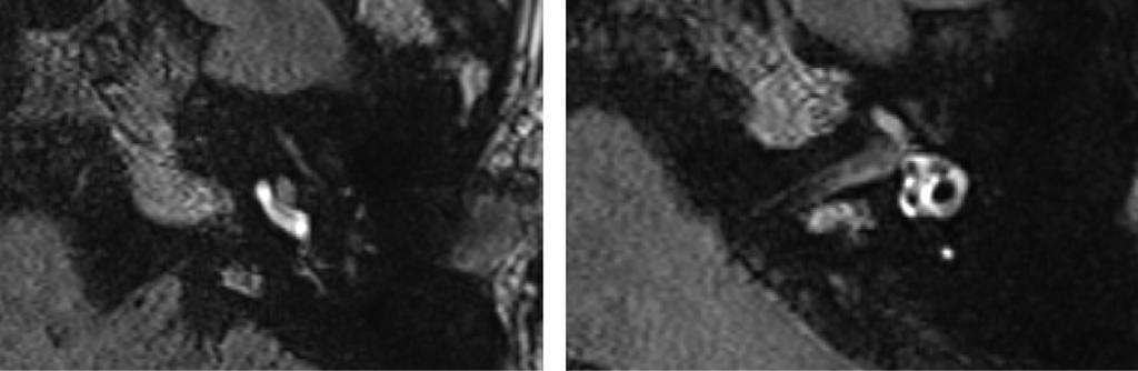서영준외 3 인 A B Fig. 1. Perilymphatic spaces were enhanced in 3D-IR MRI after Gd-DTPA intratympanic injection in normal adults. (A) in cochlea, all turns seen well enhanced diffusely.