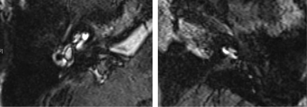 After Gd-DTPA intratympanic injection, 3D-IR MRI (A) T2-weighted image shows membraneous labyrinth high signals. (B) T1-weighted image after Gd-DTPA enhanced.