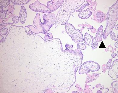 대한산부회지제 53 권제 5 호, 2010 A B Fig. 3. Pathologic findings. (A) Gross picture of the molar placenta (arrow) showing a diffuse cluster of molar vesicles.