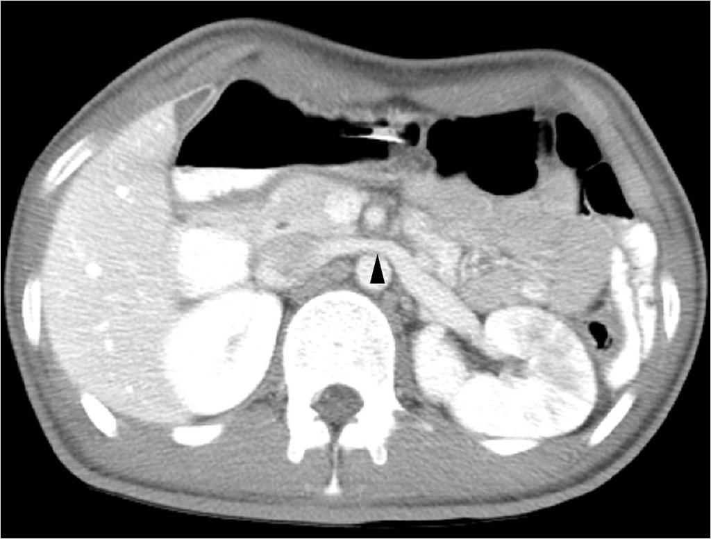 Follow-up computed tomography (CT) scan acquired 12 days after the initial CT demonstrates partial resolution of the compressed common left renal vein (black arrowhead) between the aorta and the