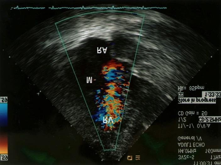 73 g/dl으로 정상이었고, ST 159 IU/L, 우심방의 대부분을 차지하면서 삼첨판을 통해 우심실로 LT 138 IU/L, LP 277 IU/L, γ-gt 19 IU/L, LDH 이어지는 7 9 cm 크기의 소엽상의(lobulated) 불균일성 Fig. 1. : four chamber transthoracic echocardiogram color Doppler showing turbulent flow indicating disturbed right ventricular inflow.