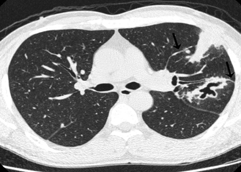 Pleuropulmonary paragonimiasis in a 71-year-old man presented with fever for 1 month.