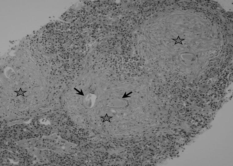 . Microscopic examination reveals multiple granulomas (stars) containing eggs of