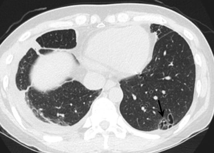 ground-glass opacity in right upper lobe, a peripheral nodule in right lower