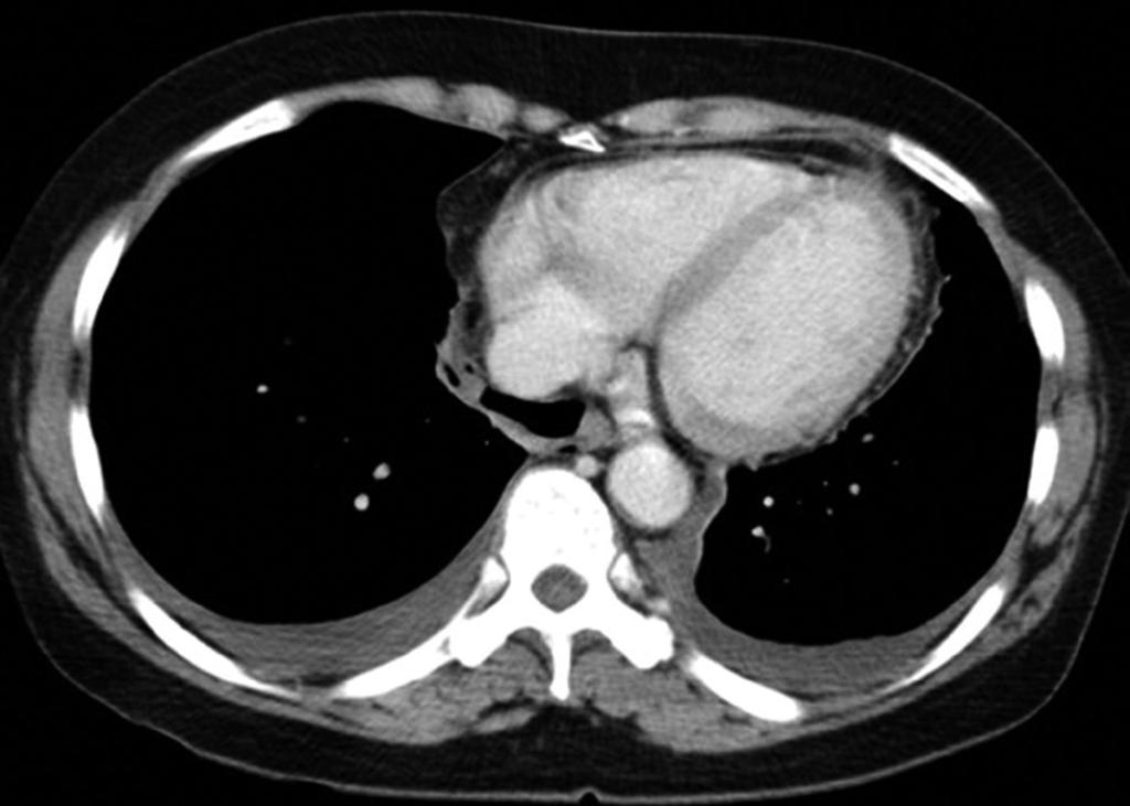 avity in left lower lobe was changed to thin-walled cysts (arrow in F). Fig. 8.