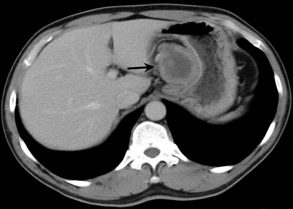 effusion with abscess (arrow) on the left.