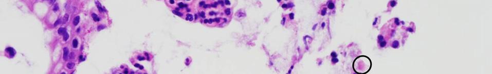 Cells were stained with hematoxylin and eosin. Image is 400. Figure 3. Follow-up colonoscopy findings.