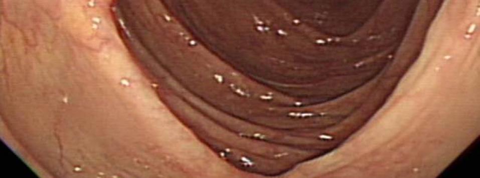 Giardia lamablia는주로소장점막상피세포에부착하여소장의흡수능력을감소시키고, 장간막의섬모에손상과위축을일으킨다. 대장에서도발견되지만비침습성병원체여서설사를일으키는기전은뚜렷하지않다 [5,9].