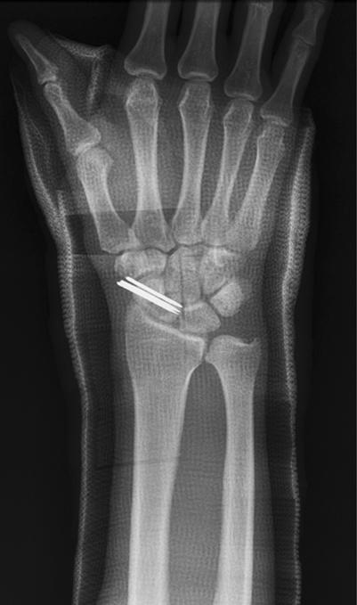 scaphoid waist fracture and nonunion.