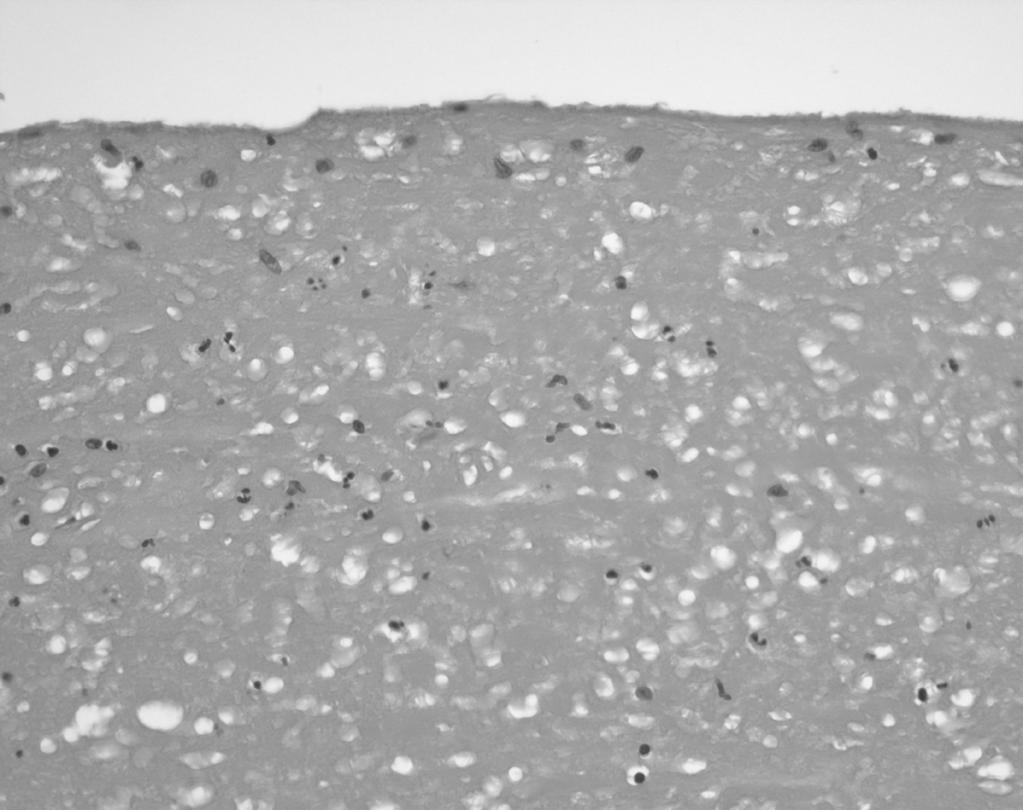 71 만성 견봉하 및 삼각근하 점액낭염에 발생한 다발성 쌀소체의 수술적 치료 Figure 5.