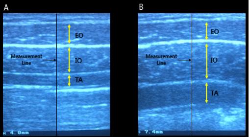 논의 Figure 3. Data acquisition Figure 4. Ultrasound imaging of abdominal muscles A:rest, B:AHE 상호작용은나타나지않았다. 하지만 IO 에서대조군과 실험군내의휴식상태와 AHE 는각각유의한차이를보 였다 (p<.000, p<.01, Table 3, Table 4).