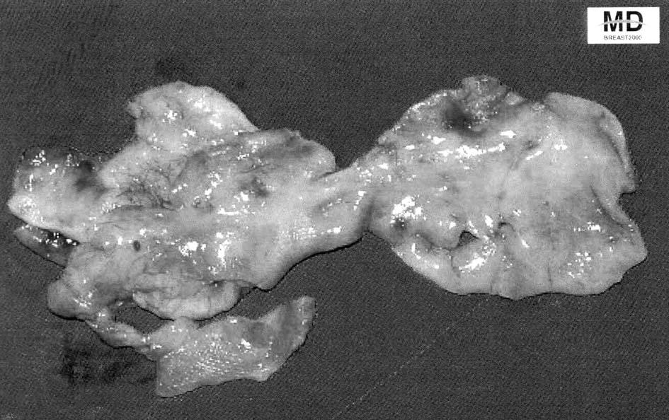 124 한국유방암학회지 제 7 권 제 2 호 2004 ꠏꠏꠏꠏꠏꠏꠏꠏꠏꠏꠏꠏꠏꠏꠏꠏꠏꠏꠏꠏꠏꠏꠏꠏꠏꠏꠏꠏꠏꠏꠏꠏꠏꠏꠏꠏꠏꠏꠏꠏꠏꠏꠏꠏꠏꠏꠏ Fig. 2. Capsulectomy specimen. Table 9.
