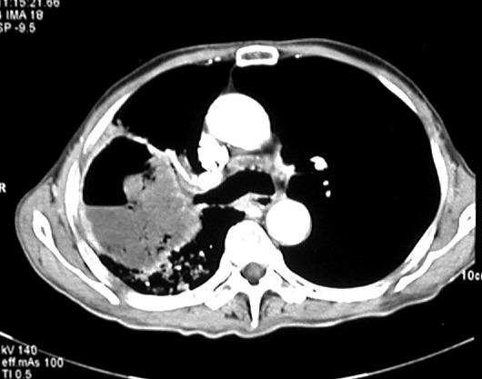 EM Hwang, et al.: A case of central diabetes insipidus in patient with non-small cell lung cancer Figure 3. Chest CT shows large consolidation with air-fluid level.