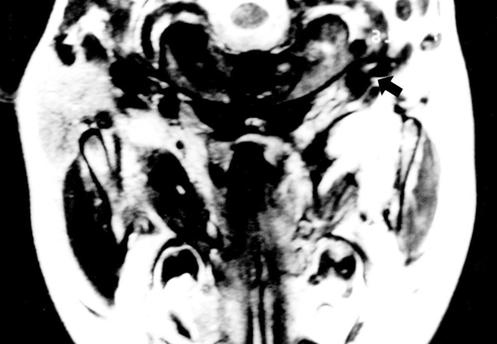 이 종물은 이후 점점 커지는 양상 약물요법(VAC)을 9주간 시행하였고 자기공명영상을 이용 을 보였으며 내원당시 비폐색을 호소하였다. 좌측 이하부의 한 추적 검사상에서(Fig. 5B) 종물이 크기가 5 cm 정도로 Fig. 4. Pathologic findings of embryonal rhabdomyosarcoma.