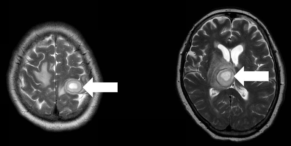 경희의학제 32 권제 1 호 2017 Fig. 2. Brain magnetic resonance imaging showing multiple brain abscesses (white arrow). 당시신체검사소견에서혈압 125/77 mmhg, 맥박분당 105회, 호흡분당 40회, 맥박산소포화도 (SpO 2, 이하산소포화도 ) 77%, 체온 37.5 였다.