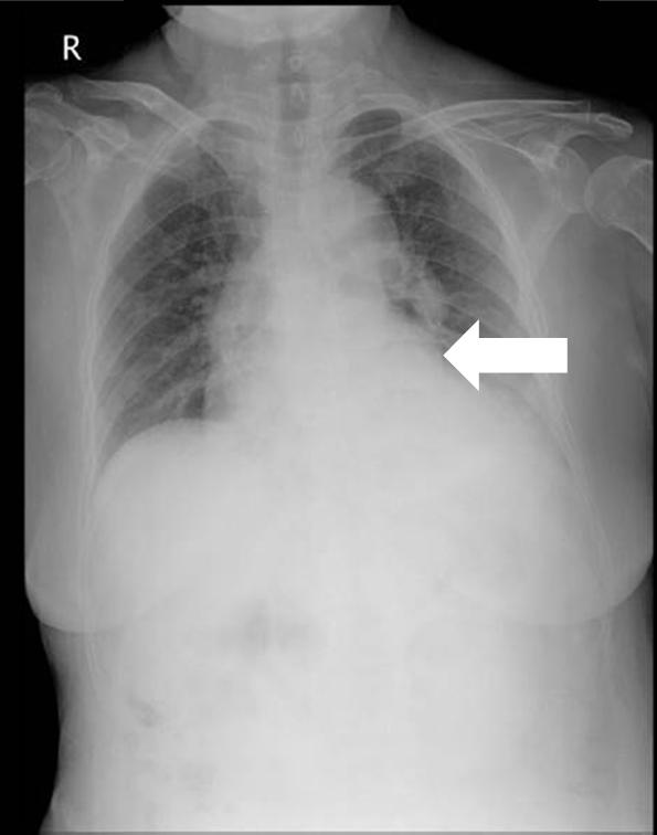 경희의학제 32 권제 1 호 2017 Fig. 3. Chest radiography showing pulmonary arteriovenous malformation in left lower lobe (white arrow).