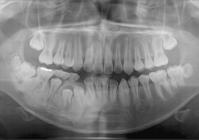 Swelling on left alveolar ridge & left mandibular area