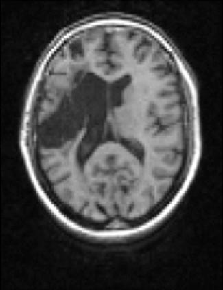 Meinzer 등 26 은만성뇌졸중후실어증환자에서하루에 3시간 10일간 CILT를실시한후환자의뇌병변주변의영역에서 MEG delta dipole density (DDD) 의감소를관찰하였으며이는뇌의가소성이증가한것임을시사한다 (Fig. 1).