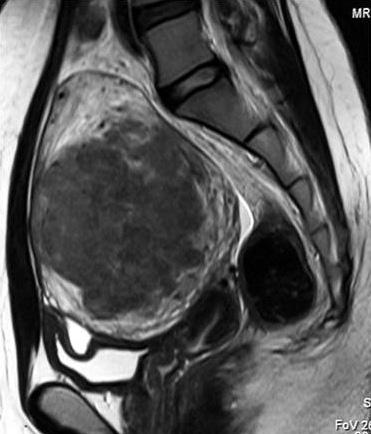 이웅희외 A B C D Fig. 2. Uterine fibroid. A, B. Pre-procedural MRI on T2-weighted sagittal image (A) and gadolinium enhanced T1-weighted image (B).