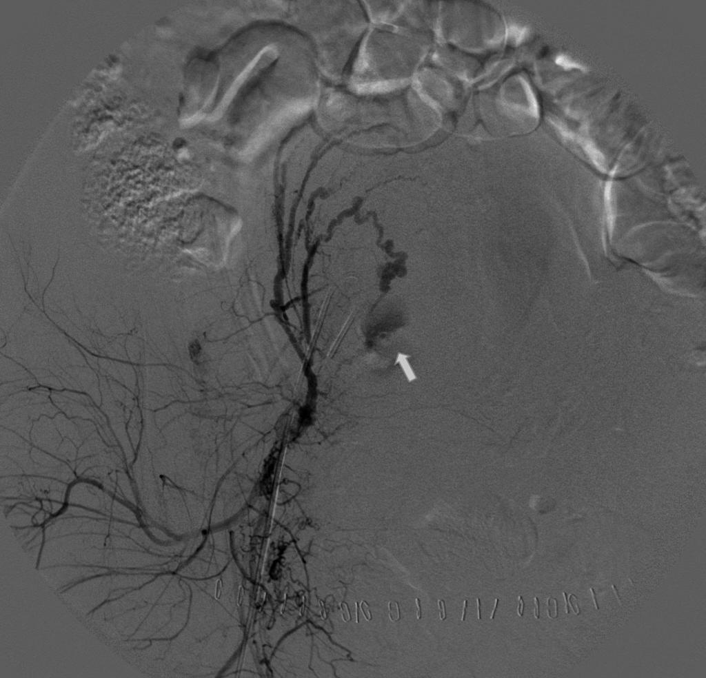 이웅희외 A B Fig. 3. Angiographic findings of post-partum hemorrhage. A. Right uterine angiogram shows contrast media extravasation (arrow) from right uterine artery branch.