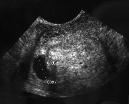 자궁동맥색전술 A B C D Fig. 5. Cornual ectopic pregnancy. A. Gestational sac was surrounded by an asymmetric myometrial mantle. B. Right uterine angiogram before embolization.