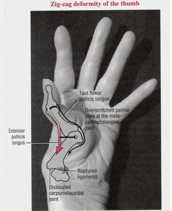 Rheumatoid arthritis Zig-zag deformity of the thumb This deformity involves
