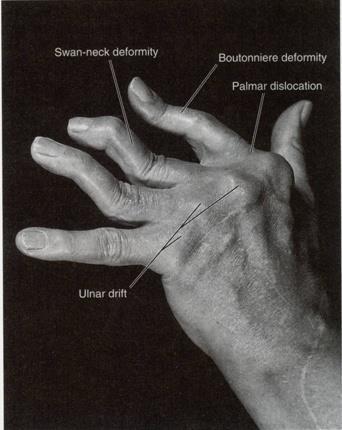Rheumatoid arthritis Ulnar drift deformity at the MCP joint consists of an excessive ulnar deviation and ulnar translation or slide of the proximal phalanx.