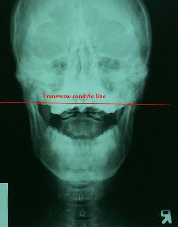 ( 다 ) AP Open Mouth 1 Transverse Condyle line