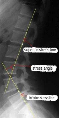 (2) 요추 ( 가 ) stress angle 1 요추의스트레스각을재기위하여 superior stress line을작도할때 L1이기준이고 inferior stress line을작도할때 L5가기준이다.
