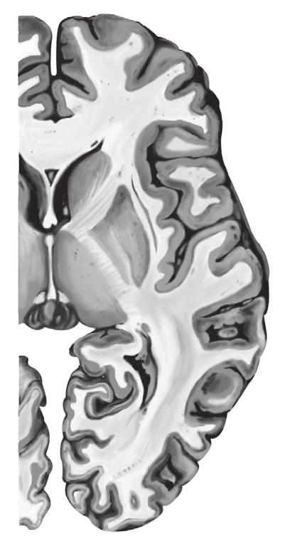 internal capsule Thalamus Tail of caudate nucleus Temporal horn of