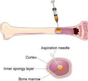 Bone Marrow Transplantation In the 1950 s, bone marrow transplantation began to