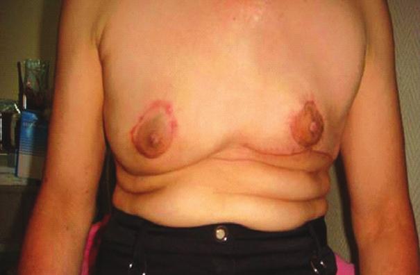 (D) 60-year-old woman with the grade II of