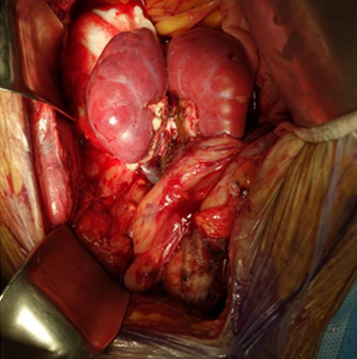 J Korean Soc TransplantㆍSeptember 015ㆍVolume 9ㆍIssue 3 Fig.. (A, B) Implantation of en bloc kidneys with partial bladder segment. Fig. 3. (A) Doppler ultrasonogram (U/S) image.