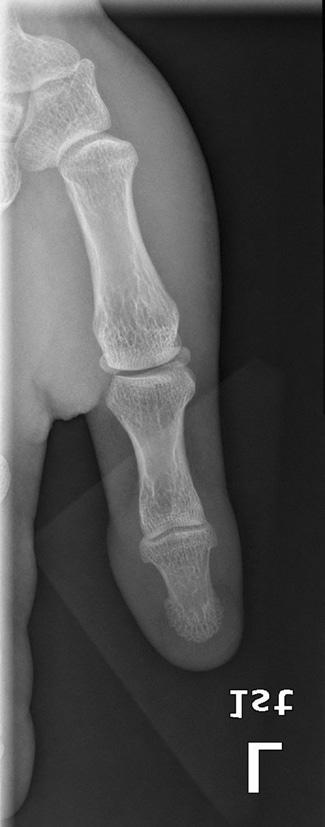 장무지신전건의근위부및원위부파열부위를변연절제술을시행하고동측장장근건 (palmaris longus tendon) 을채취한후파열부위사이에건이식술 (tendon graft) 시행하여장무지신전건재건술 (EPL tendon reconstruction)