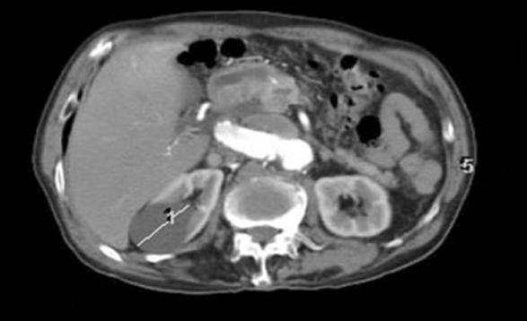 carcinoma 7 54 M Retroaortic left renal vein Aortoiliac occlusive disease Fig. 1.