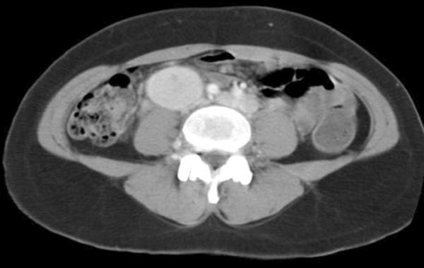 수술 전 시행한 컴퓨 터 단층촬영상 하대정맥이 좌신정맥(left renal vein)에 연결 되어 있고, 신정맥