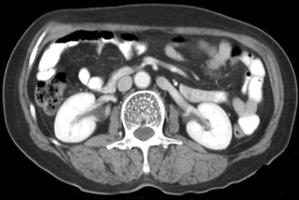 치료하였다. 종양의 조직학적 소견은 거대림프절(giant lymph node)이었다.