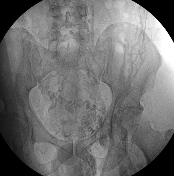 collaterals and no visible both iliac vein and inferior vena cava.