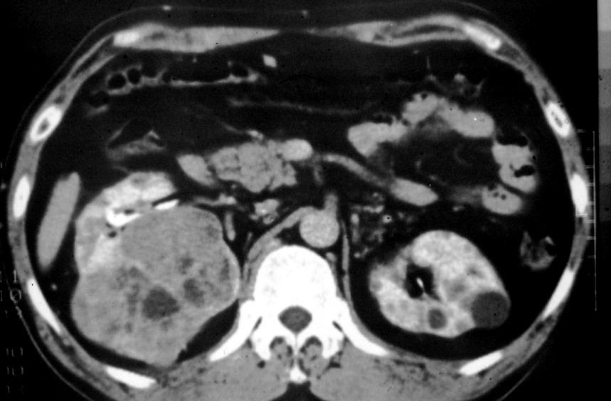 (B) Operative finding shows no visible inferior vena and dilated right