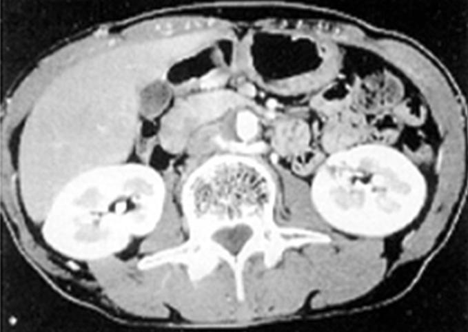 (B) Computed tomographyangiography shows totally occluded infrarenal