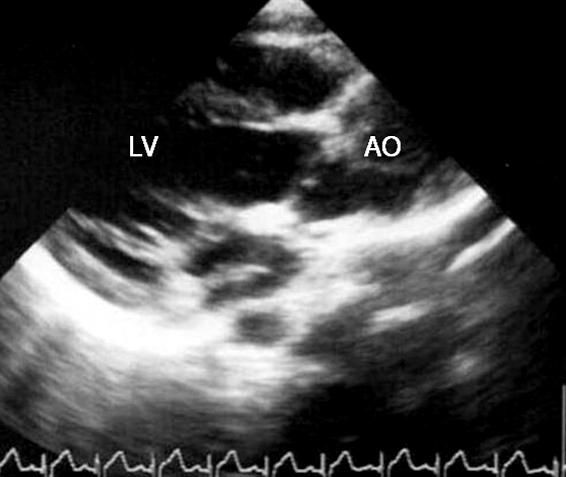 대흉외지 2010;43:58-62 Fig. 2. Transthoracic echocardiography in Case II patient (parasternal long axis view). (A) Preoperative echocardiography shows VSD, PA arising from LV, thickened PV.