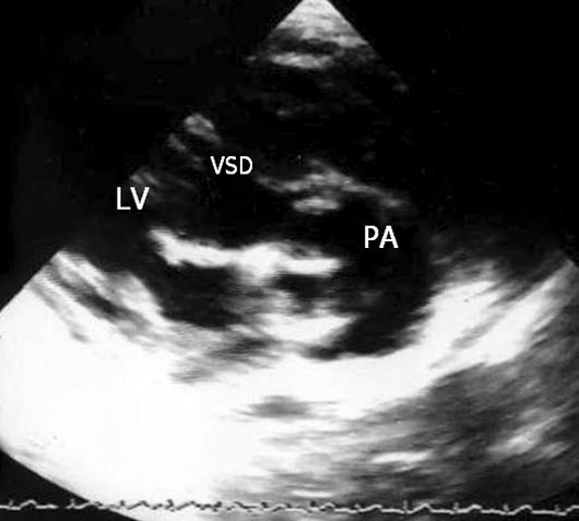 LV=Left ventricle; PA=Pulmonary artery; VSD=Ventricular septal defect; AO=Aorta. 전과비교하여거의정상범위로성장하고있었다 (Table 1). 약간의대동맥판막역류가남아있지만좋은심실기능을유지하고있고, 현재특별한증상없이 73개월째외래추적관찰중이다 (Fig. 1). 증례 2 생후 103일된남자환아로우연히발견된심잡음으로시행한심초음파에서대혈관전위를진단받고본원으로전원되었다.