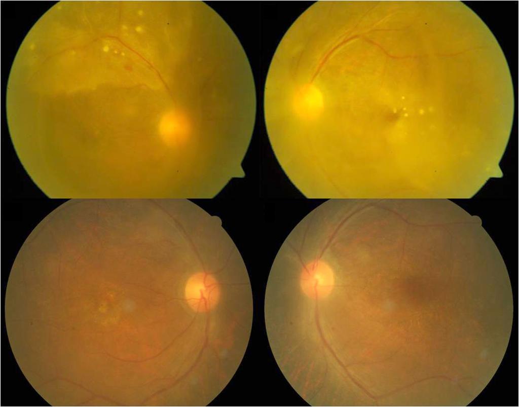 - 곽현덕외 : 매독포도막염 - A B C D Figure 2. Syphilitic uveitis. (A, B) Fundus photograph showed vitritis, retinal vasculitis and inflammatory retinal infiltration in both eyes.