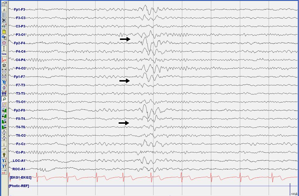 A B Fig. 4. The result of electroencephalography (EEG). A: There is one episode of less well organized generalized slow spike and wave discharge with both frontal dominancy (Rt>Lt).