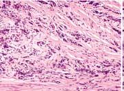암세포가 mesothelial cell과붙어있거나, 복강으로노출되어있는경우는 pt3로분류한다 (Fig. 4). 암세포가 pancreas capsule을관통하면 pt4로분류한다.