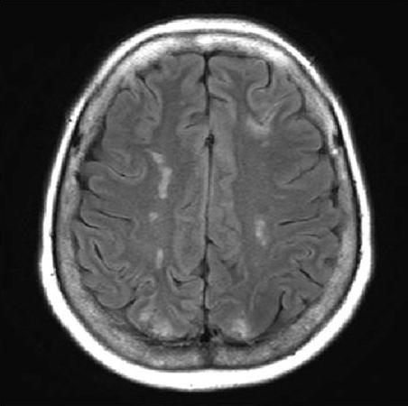 rain magnetic resonance imaging (MRI)